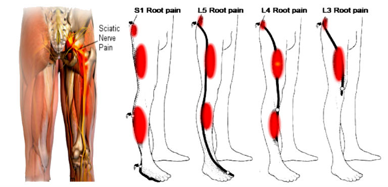 Sciatica, Rockville MD