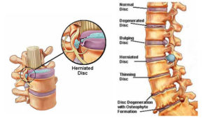 Disc Pain & Herniation