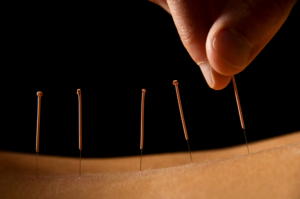 Low Back Pain Acupuncture Treatment Washington DC