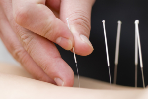 Acupuncture Covered by Medicare Rockville MD